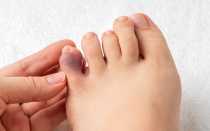 Ушиб мизинца на ноге чем лечить