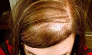 Причины и лечение себорейной алопеции у женщин