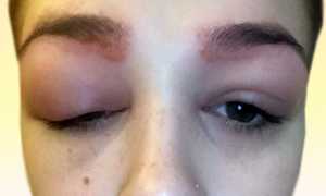 Аллергия на хну для бровей