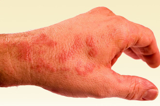 Сыпь на коже представлена узелками и пузырьками Сыпь