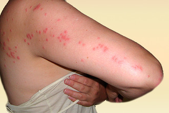 Покраснение при аллергической реакции на укус мошки Покраснение