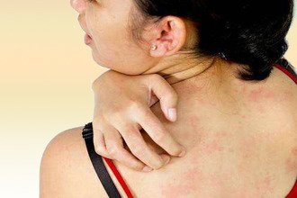 Сыпь и зуд кожи при аллергической реакции Зуд