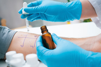 О положительном результате говорит появление покраснение Кожные пробы