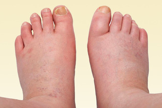 Припухлость бывает ярко выраженной, мешающей ходьбе Ноги