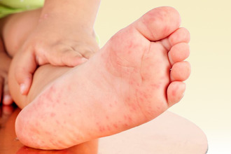 В своем развитии заболевание проходит несколько стадий Аллергия