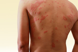 Аллергический контактный дерматит приводит к появлению пятен на коже Аллергия