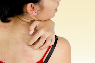 Аллергия развивается вследствие дисфункции иммунной системы Дерматит