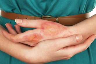 К сожалению, полностью вылечить дисгидроз кистей нельзя, так как процесс имеет хроническое течение Руки