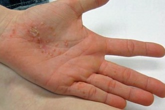 Одним из самых неприятных хронических заболеваний кожи верхних конечностей является дисгидроз кистей рук Дисгидроз кистей рук