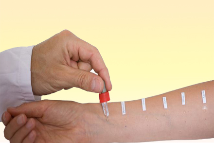 Кожные аллергопробы Аллергопробы