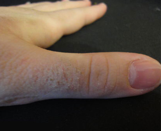 Аллергия на коже рук Воспаление на коже рук