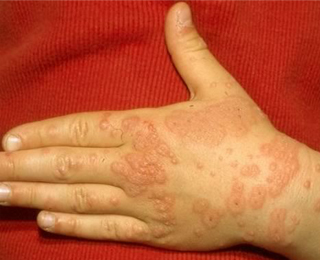 Кожная сыпь при аллергии Кожная сыпь