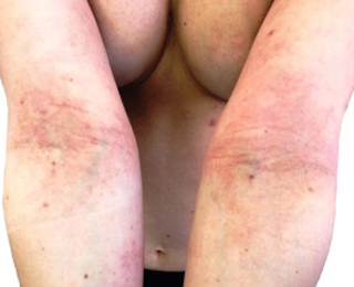 Атопический дерматит Дерматит