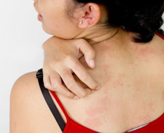 Сыпь и зуд при дерматите Сыпь и зуд