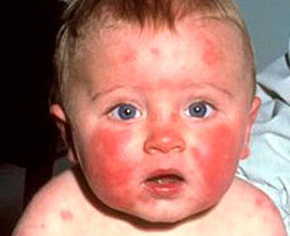 Последствие солнечной аллергии Солнечная аллергия