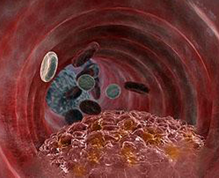 Проявление атеросклероза Атеросклероз