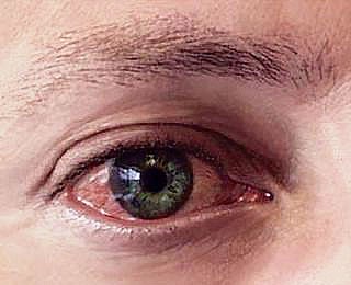 Иммунная реакции немедленного типа Риноконъюктивит