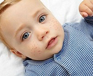 Сыпь на лице из-за аллергии Сыпь