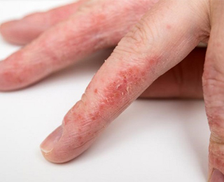 Аллергия на пальцах рук На пальцах рук