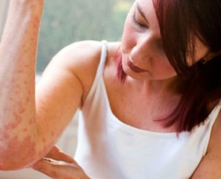 Тепловая крапивница Крапивица