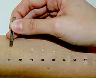 Кожные пробы