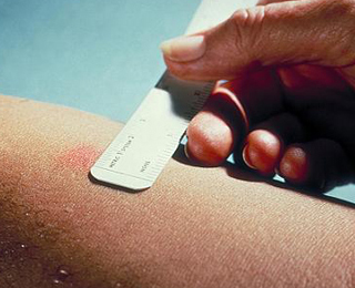 Возникновение аллергической реакции на Манту Реакция на Манту