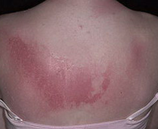 Фототоксический дерматит Покраснение на спине