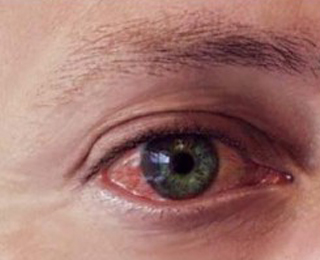 Конъюктивит