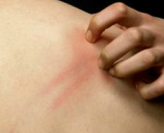 Зуд на коже Зуд