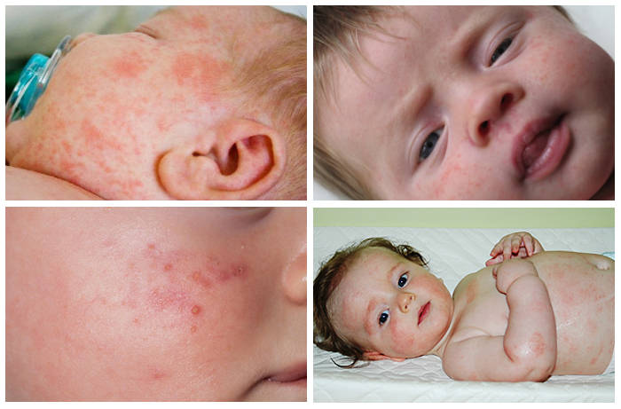 Фотографии пищевой аллергии у младенцев Фотографии пищевой аллергии у грудничков