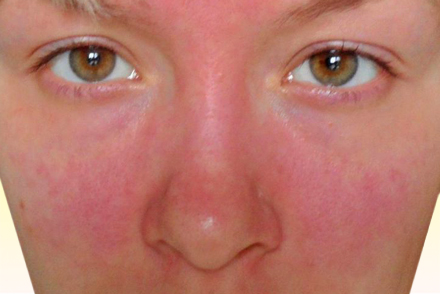 Покраснение кожи 