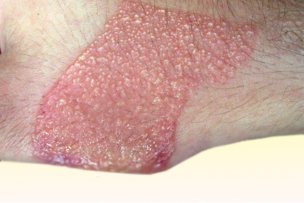 Ирритативный дерматит Пятна и шелушение кожи