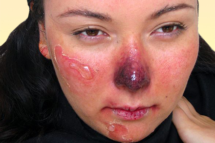 Обморожение 