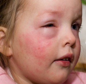 Как выглядит отек Квинке у детей Отек Квинке на глазу у ребенка