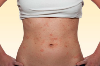 Мелкая сыпь в виде пятен – один из симптомов Сыпь