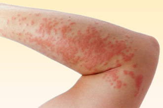 Крапивница - наиболее распространенная реакция Крапивница