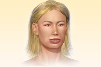 При отеке Квинке определяется только выраженная припухлость Отек Квинке