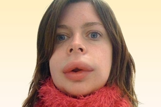 Отек Квинке локализуется в области глаз, носа, губ, щек Отек Квинке