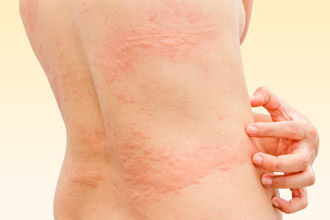 Крапивница – один из симптомов на препарат Крапивница