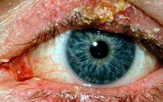 Симптомы болезни