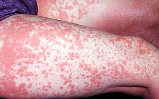 При появлении первых признаков болезни сразу же обращаемся к специалисту Симптомы аллергического васкулита