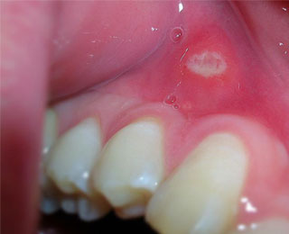 Афтозный стоматит Эрозия на слизистой рта