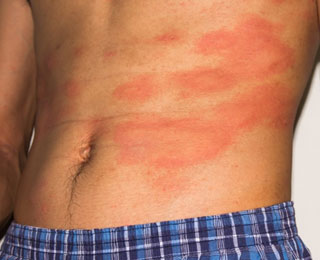 Аллергическая реакция на животе Красные пятна на животе