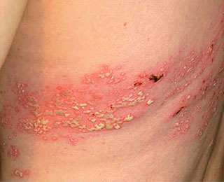 Опоясывающий лишай Высыпания на спине и боку