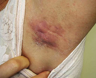 Хронический дерматит Синюшная подмышечная впадина