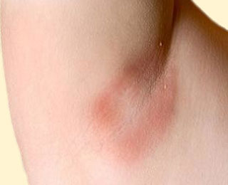 Простой контактный дерматит Небольшое покраснение подмышкой