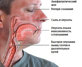 Симптомы анафилактического шока