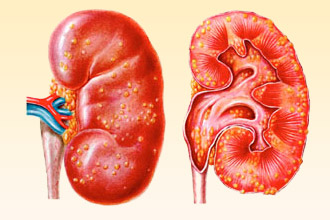 Интерстициальный нефрит - один из симптомов Интерстициальный нефрит