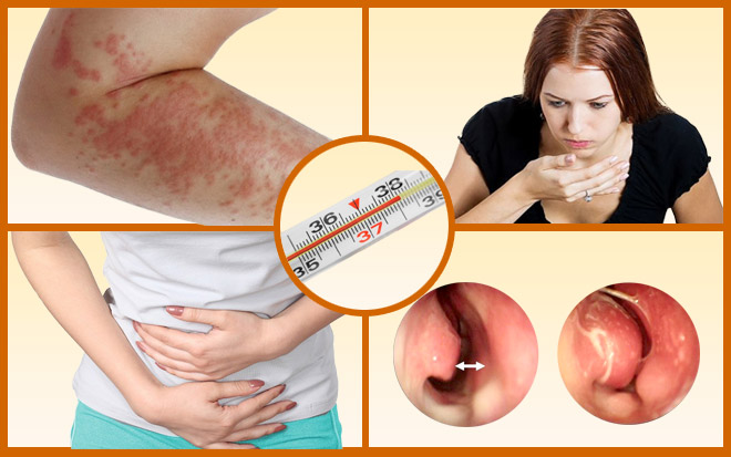 Симптомы, возникающие при употреблении пыльцевых частиц в пищу. Дополнительные симптомы