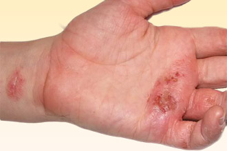 Контактный дерматит – один из возможных симптомов Контактный дерматит
